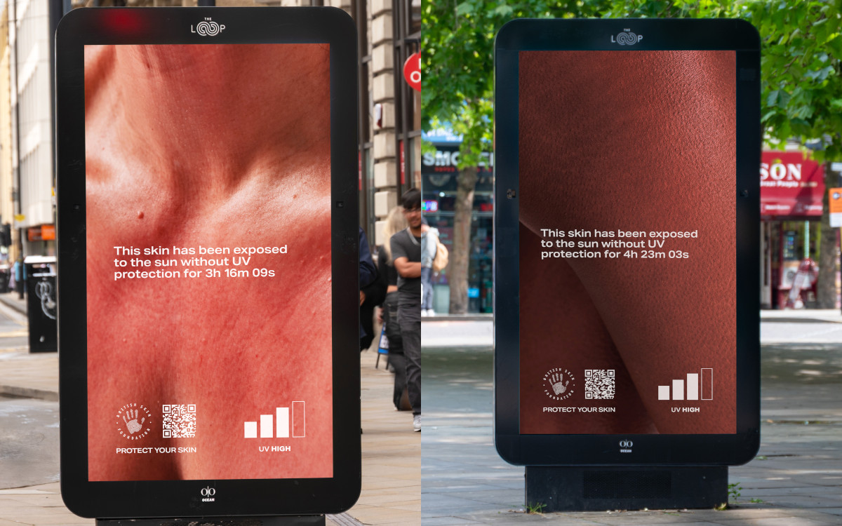 Das Burnable Billboard zeigt verschiedene Stadien von Sonnenbrand. (Fotos: Ocean Outdoor)